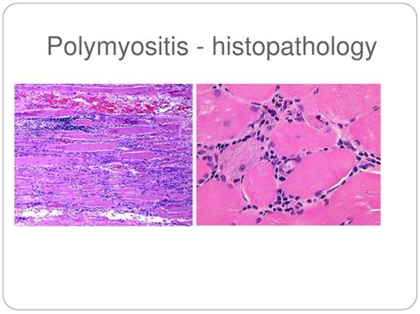 Ppt Inflammatory Myopathies Powerpoint Presentation Free Download