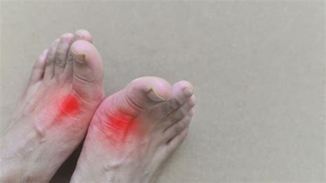 How to Relieve Gout Pain in Foot | Tips & Remedies For Gout in Feet