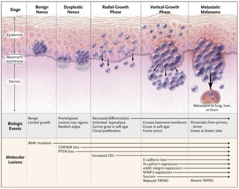 Chart Abcde Melanoma - The Abcde Rule Of Skin Cancer - AFD Get the ...