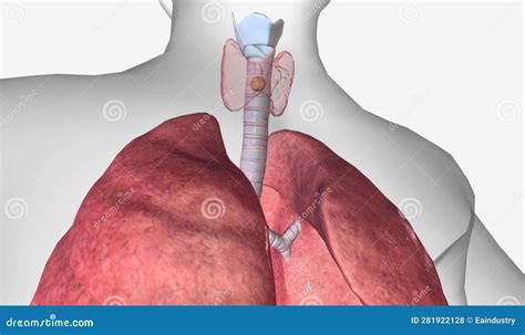 In Stage II Thyroid Cancer, the Tumor is between 2 and 4 Cm Acro Stock Illustration ...