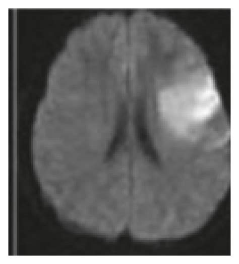 MRI image of cerebral infarction. | Download Scientific Diagram