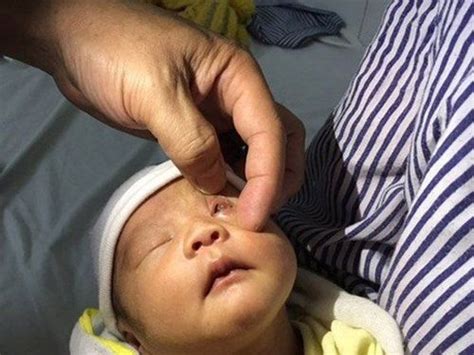 Why Is It Important To Screen For Retinopathy Of Premature Babies Vinmec