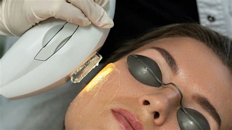 Flawless Complexion No Filters Needed Experience Ipl Photofacial In