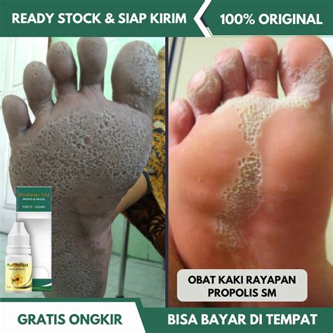 Jual Obat Kaki Bolong Bolong Telapak Kaki Rayapan Rorombeheun Obat