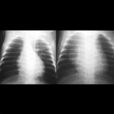Pediatric Viral Pneumonia | Pediatric Radiology Reference Article