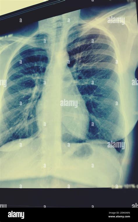 Une Radiographie Des Poumons Radiographie Du Thorax Ou Du Poumon Du