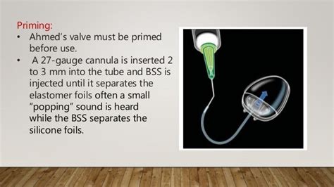 Glaucoma Drainage Devices