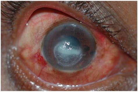 Fungal Keratitis Eyewiki Hot Sex Picture