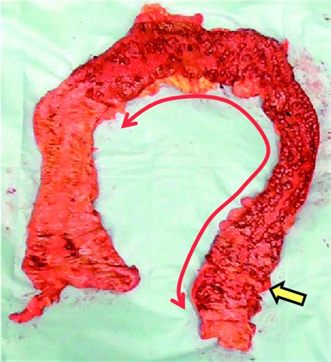 Perforation In The Sigmoid Colon Yellow Arrow And Extensive Mucosal Download Scientific