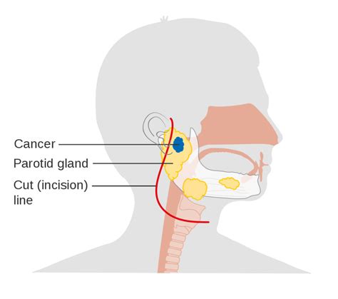 Parotid Gland Drainage