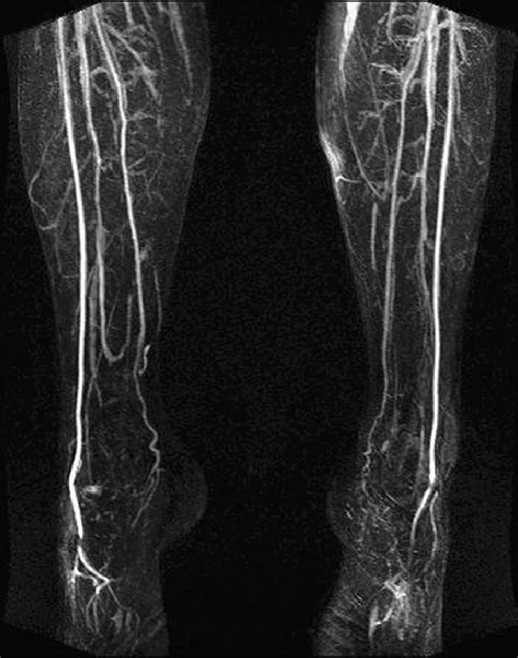 Mra Of Bilateral Lower Extremity Download Scientific Diagram