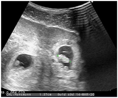 Spontaneous Heterotopic Pregnancy Case Report And Literature Review