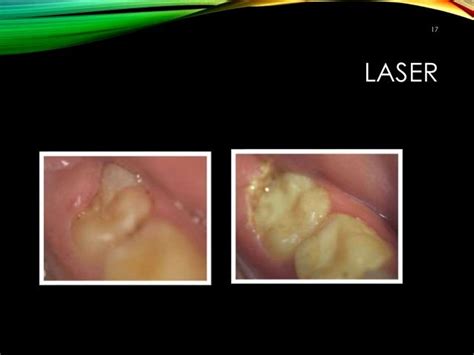 Pericoronitis