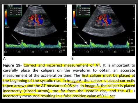 Renal doppler