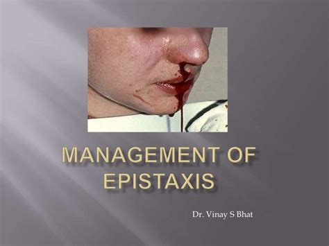 Management of epistaxis