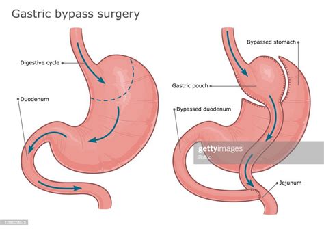 Gastric Sleeve Surgery Vs Gastric Bypass Which Is Right For You