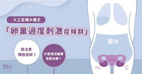 【大象醫師 周維薪】人工生殖大魔王「卵巢過度刺激症候群」：該注意哪些症狀？什麼情況需要住院治療？ 問8健康諮詢