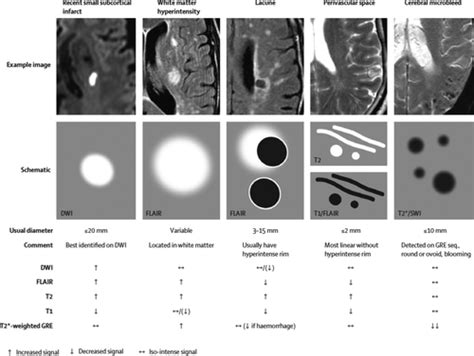 What Are White Matter Hyperintensities Made Of Journal Of The