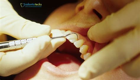 Aprende A Eliminar La Placa Dental Odontotecks