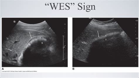 Chronic Cholecystitis Ultrasound Wes Sign