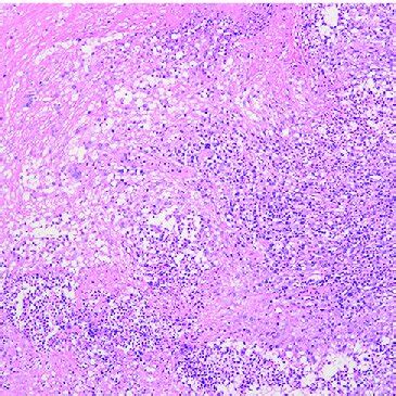 Figure. Analysis of subcutaneous nodules caused by Tropheryma whipplei ...