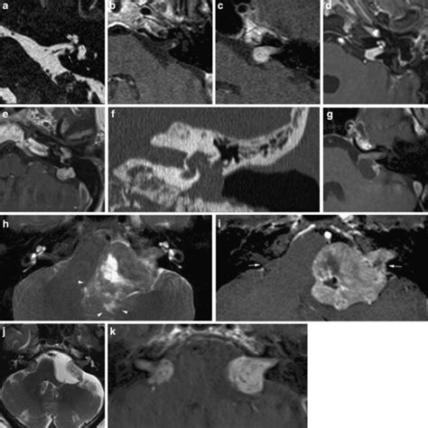 Imaging Features Of Vestibular Schwannomas A Nodular Lesion Is Seen