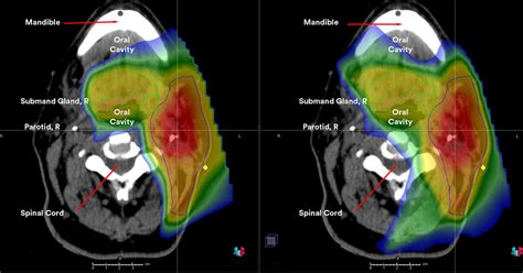 The Beam Protons For Head And Neck Cancers A Look At Our RTTs Meet