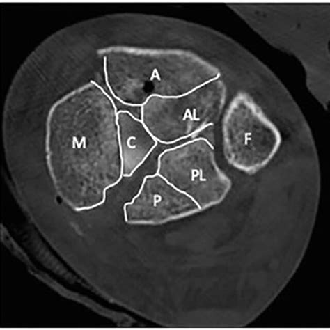 Triple Plate Orif Of A Tibial Pilon Fracture Ao Type 43 C3