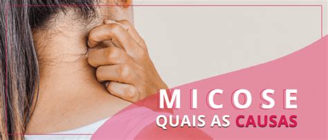 Micose O Que é E Como Identificar Cada Uma Centro De Dermatologia