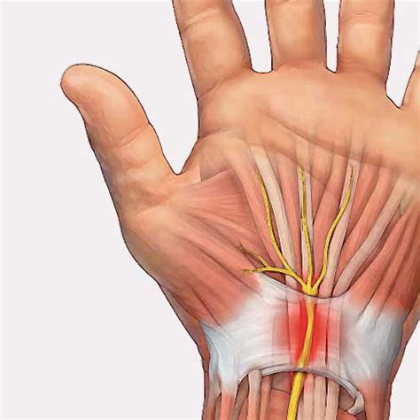 Carpal Tunnel Syndrome Causes Treatment Surgery Dr Arthur Turow