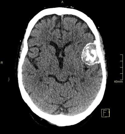 Calcified Meningioma Radiology Case Radiopaedia Org