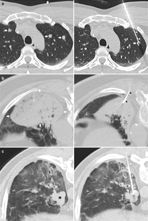 Percutaneous Transthoracic Lung Biopsy Radiology Key