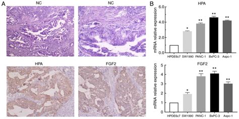 The Hpa Sdc Axis Promotes Invasion And Metastasis Of Pancreatic Cancer