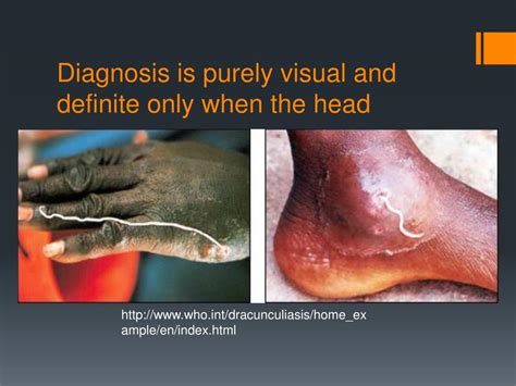 PPT - Guinea Worm Disease PowerPoint Presentation, free download - ID ...