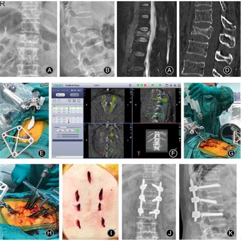 Typical Pedicle Screw Grading According To The Gertzbein And Robbins Download Scientific