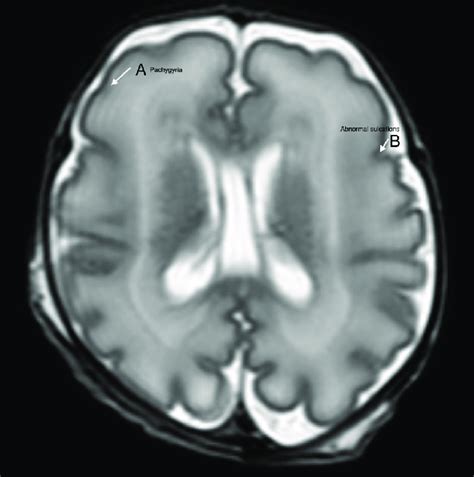 Magnetic resonance imaging (MRI) brain showing pachygyria (A) and ...