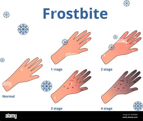 Frostbite stages, Vector cartoon illustration of hands Stock Vector Image & Art - Alamy