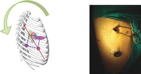 Figure From The Evolution Of Minimally Invasive Thoracic Surgery