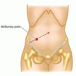 McBurney point - definition of McBurney point by Medical dictionary. a ...