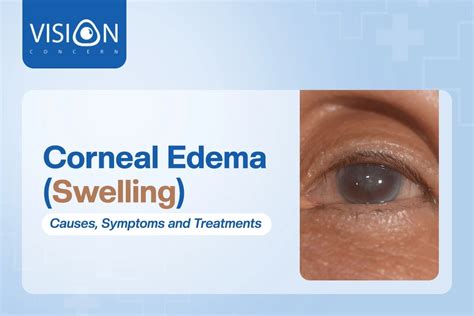 Corneal Edema Swelling Causes Symptoms And Treatment