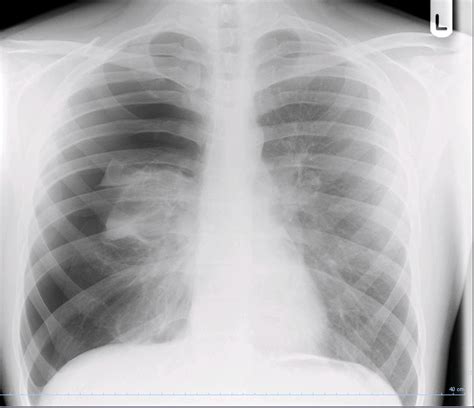 Management Of Haematuria Case Rcemlearning India