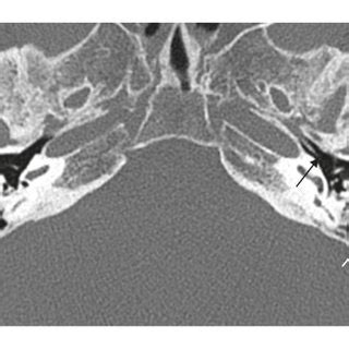 Preoperative Ac And Postoperative Df Clinical Findings A