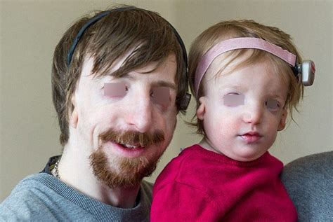 Treacher Collins Syndrome Pictures Medical Pictures And Images