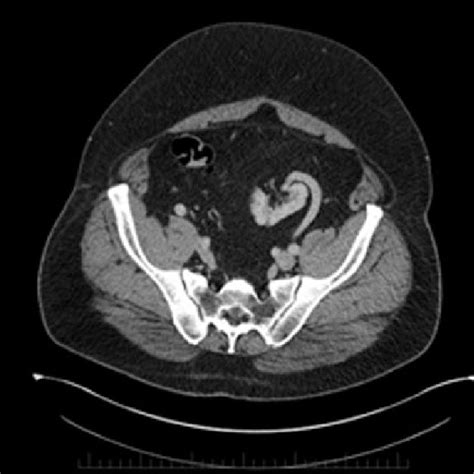 Case 1-CT urogram; sagittal image showing the proximity of ureter to ...