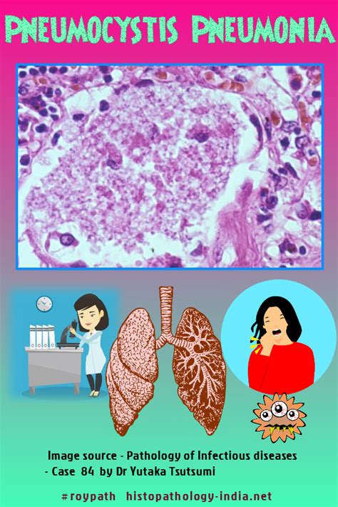 Pathology Of Pneumocystis Pneumonia Pneumonia Nursing School Survival Pathology