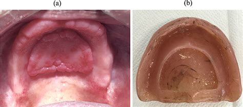 A Inflammatory Papillary Hyperplasia Caused By Vacuum Chamber B