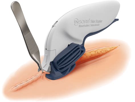 Why Suture Staple With The Insorb Absorbable Skin Stapler