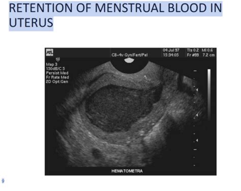 Congenital Anomalies Uterus Flashcards Quizlet