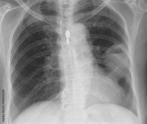 Chest X Ray Image Of Lung Abscess Stock Photo Adobe Stock