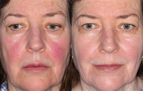 Ipl Laser For Rosacea Cosmetic Surgery Tips